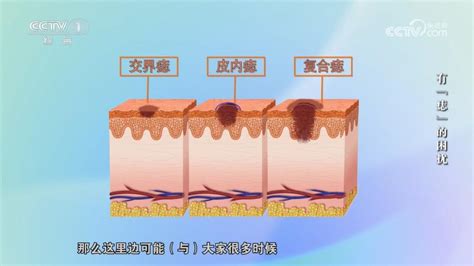 痣 凸起來|皮膚科 痣